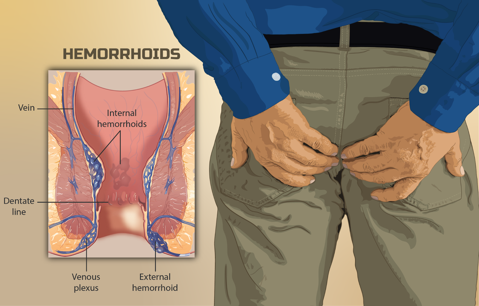 Understanding Piles (Haemorrhoids): A Complete Guide to Symptoms, Treatment, and Prevention