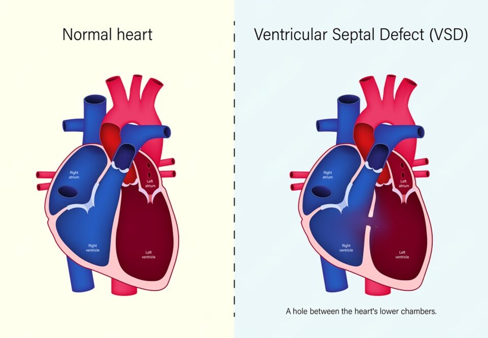 Ventricular Septal Defect (VSD): A Complete Guide to the “Hole in the Heart